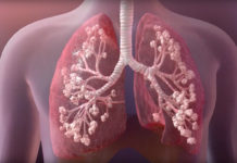 4.5% are carriers of Cystic Fibrosis gene among 200 people ; frequency to be higher in India than the west – Study by Sir Gang Ram Hospital