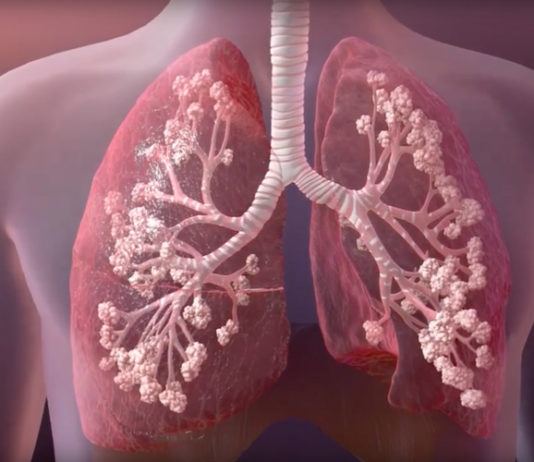 4.5% are carriers of Cystic Fibrosis gene among 200 people ; frequency to be higher in India than the west – Study by Sir Gang Ram Hospital