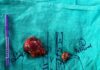 Rare and Complex Surgeries of Adernal Glands performed in Capitals’ Sir Gangaram Hospital Tumor treated in adrenal gland SGH-HealthLive