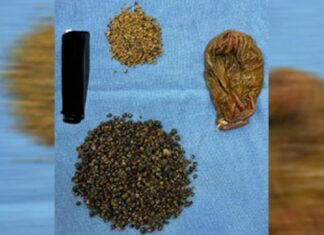 Fortis doctors remove 8125 stones from Gall Bladder in rare surgery